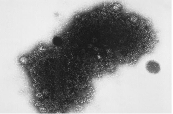 Enterovirus D68